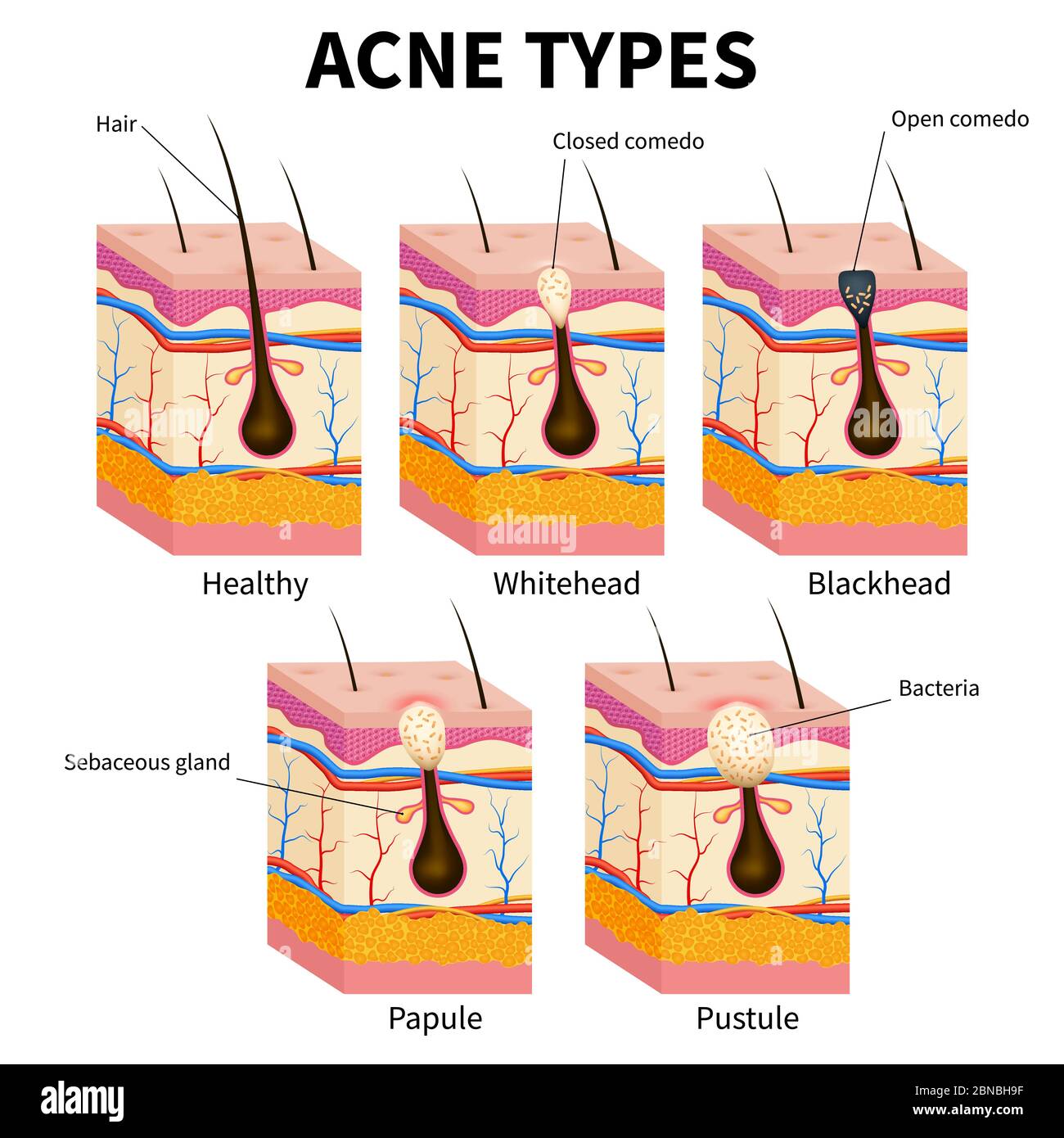 Tipi di acne. Pimple malattie della pelle anatomia diagramma vettoriale medico. Illustrazione di follicolo e pimple, anatomia della medicina, papule e pustola Illustrazione Vettoriale