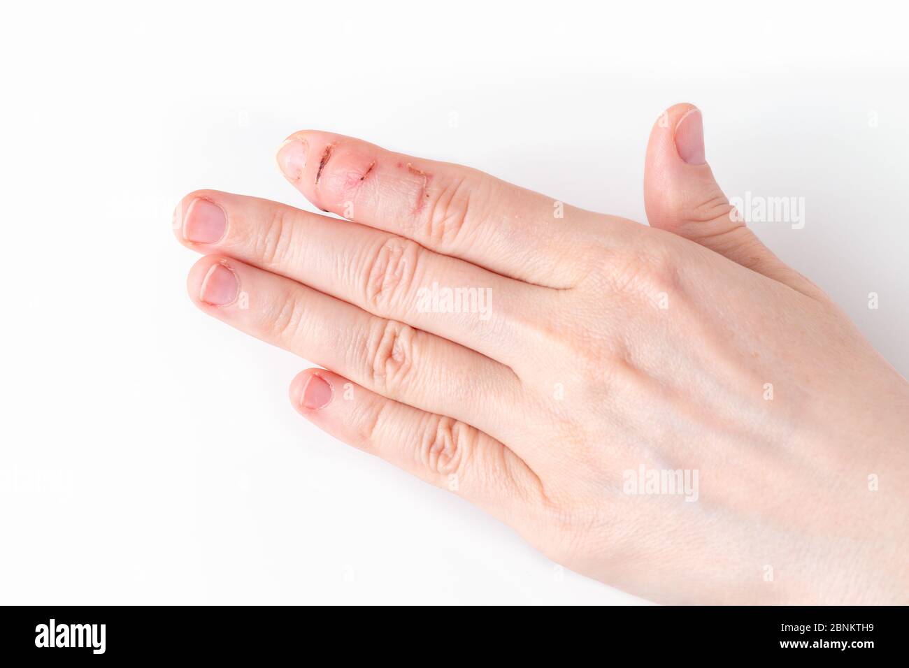 un dito indice sinistro con piaghe e cicatrici dopo lesioni, punta del dito che si piega verso il basso mentre il resto del dito rimane diritto, deformità Foto Stock
