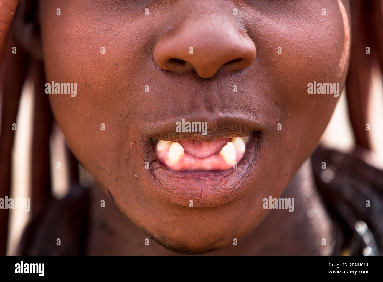 Dettagli sui denti della donna Himba, dalla comunità Himba. Kaokoland settentrionale. Namibia. Nella cultura Himba, è molto comune rimuovere i 4 denti fr Foto Stock