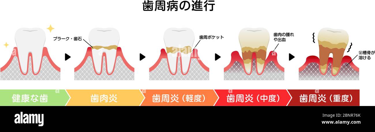 Le fasi della parodontite malattia illustrazione vettoriale Illustrazione Vettoriale
