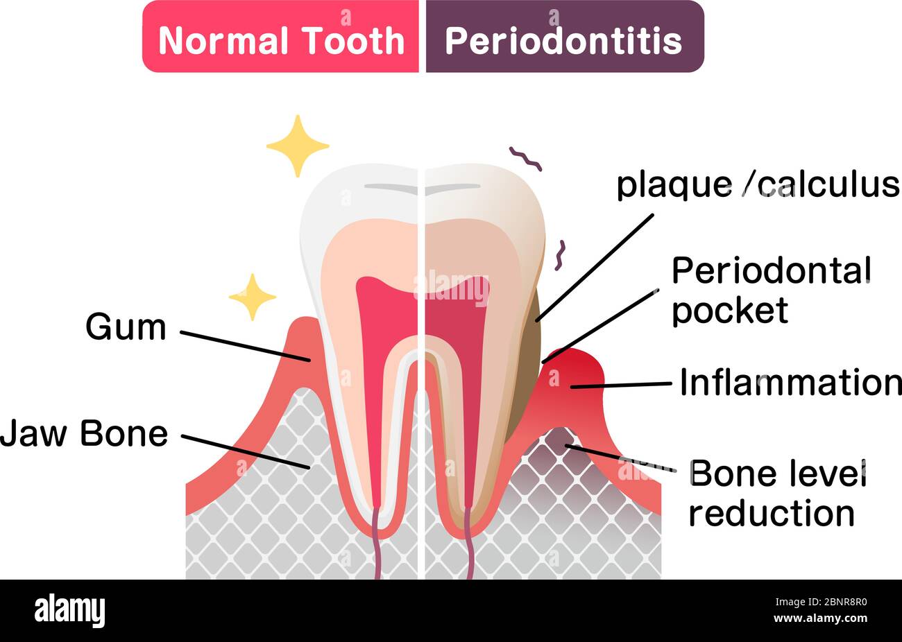Confronto tra denti normali e malattia parodontale. Illustrazione vettoriale piatta Illustrazione Vettoriale