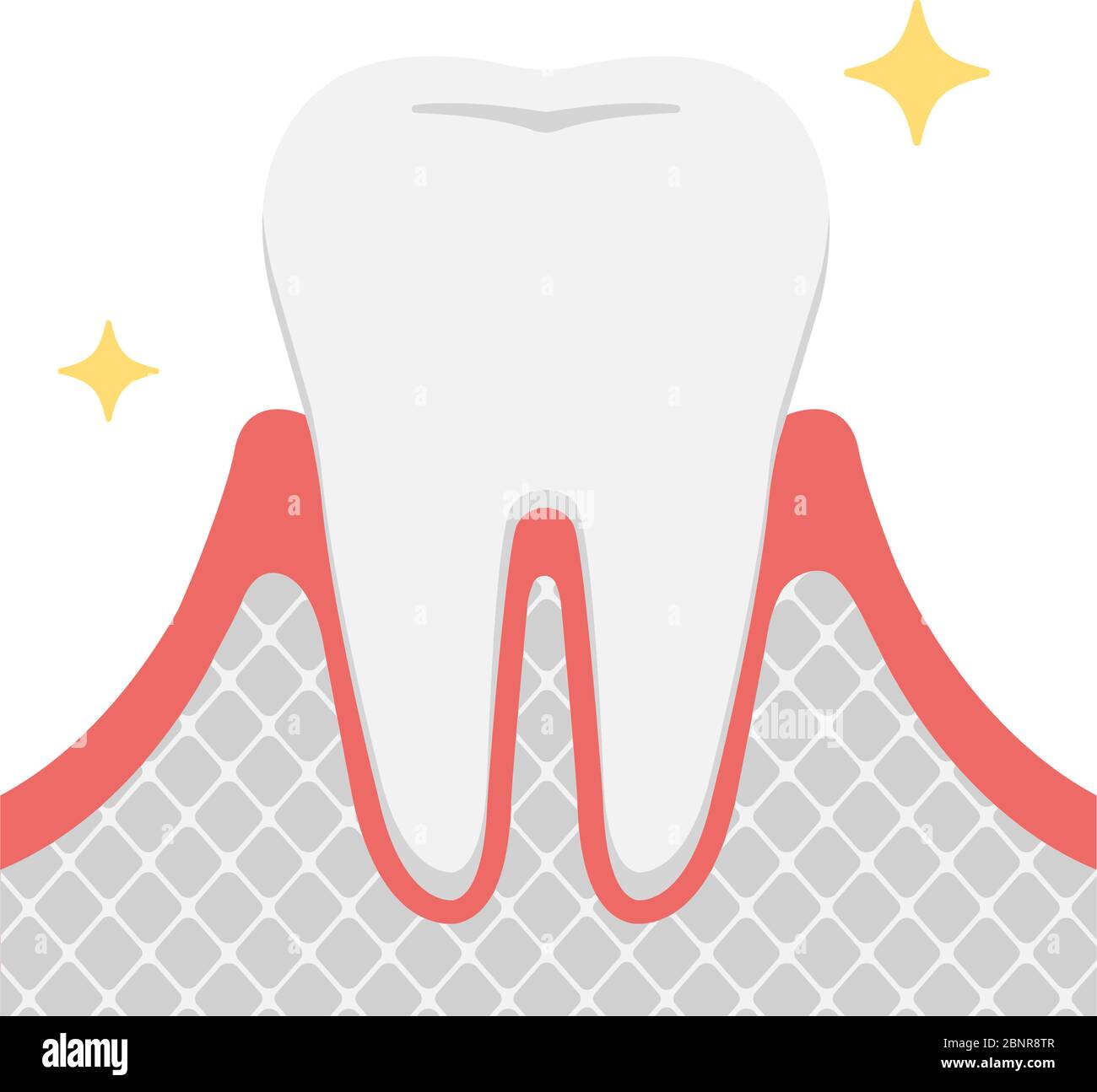 Le fasi della malattia di periodontite / dente sano Illustrazione Vettoriale