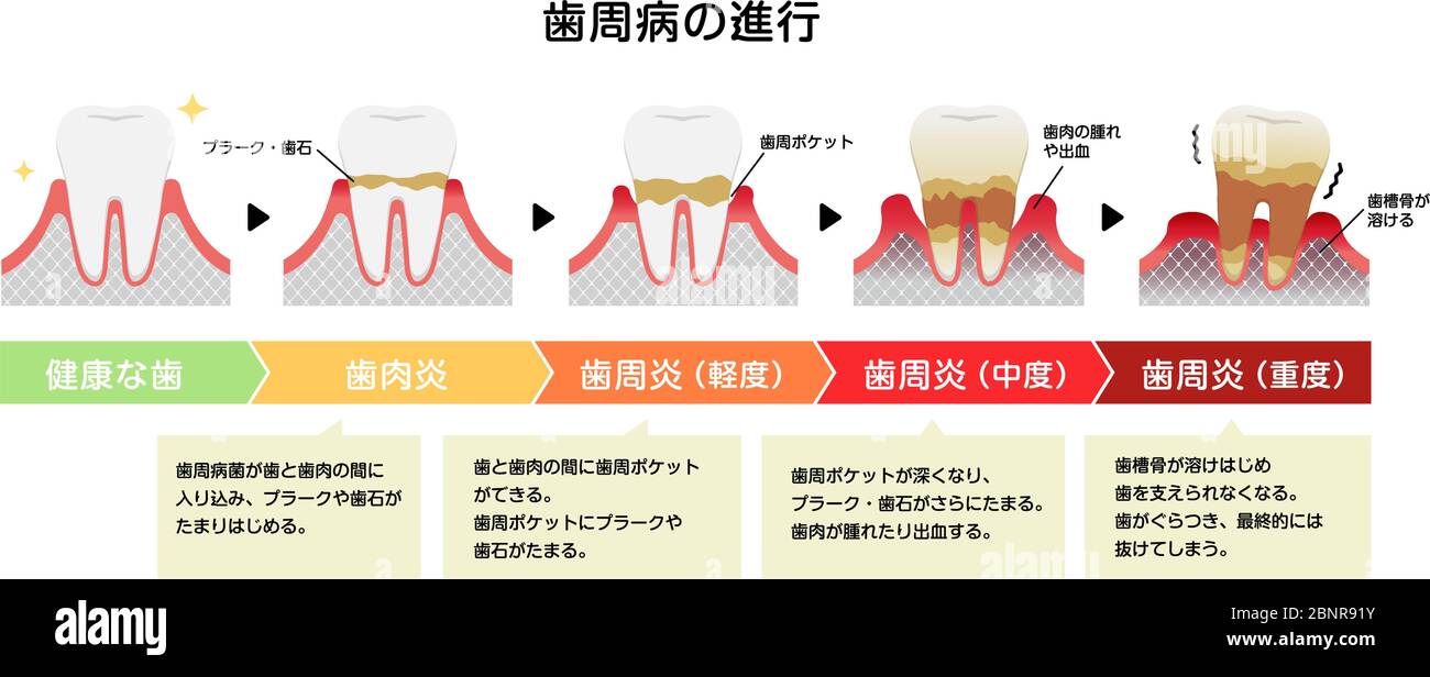 Le fasi della parodontite malattia illustrazione vettoriale Illustrazione Vettoriale
