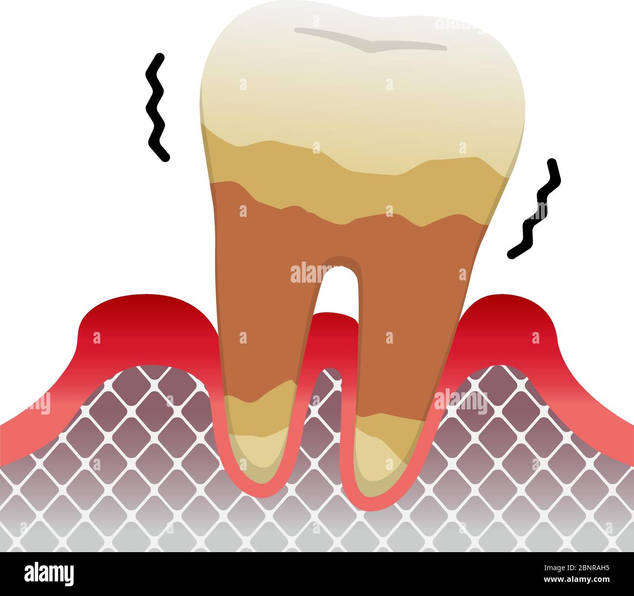 Le fasi della parodontite / grave periodontite Illustrazione Vettoriale
