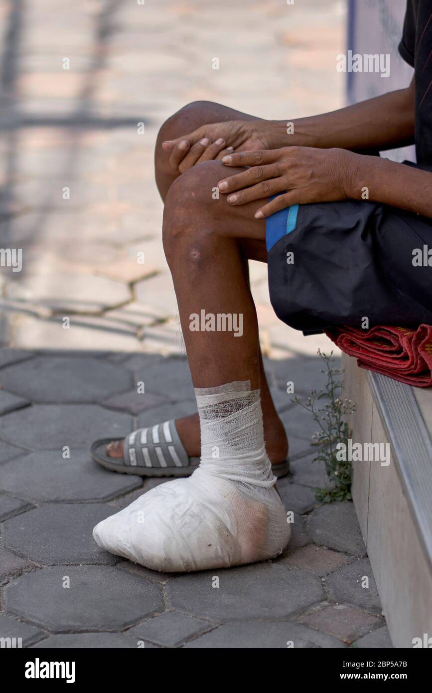 Lesioni ai piedi. Uomo con un piede pesantemente bendato. Thailandia sud-est asiatico Foto Stock