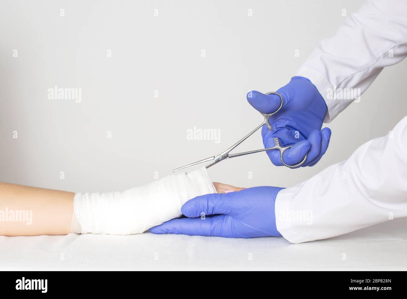 Un medico ortopedico rimuove l'intonaco dalle bende nel palmo di una ragazza utilizzando forbici mediche. Concetto di livido e frattura del palmo del han Foto Stock