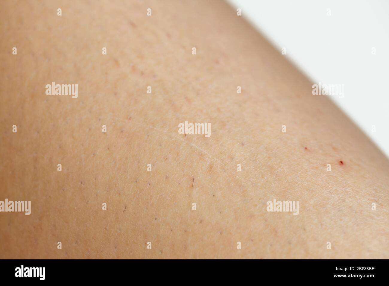 Closeup di peli incarniti e pelle irritata sulla gamba di una donna Foto Stock