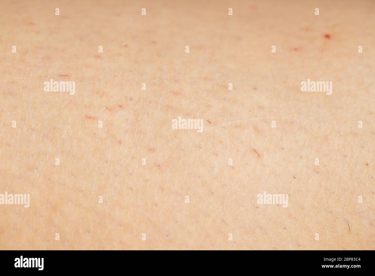 Closeup di peli incarniti e pelle irritata sulla gamba di una donna Foto Stock