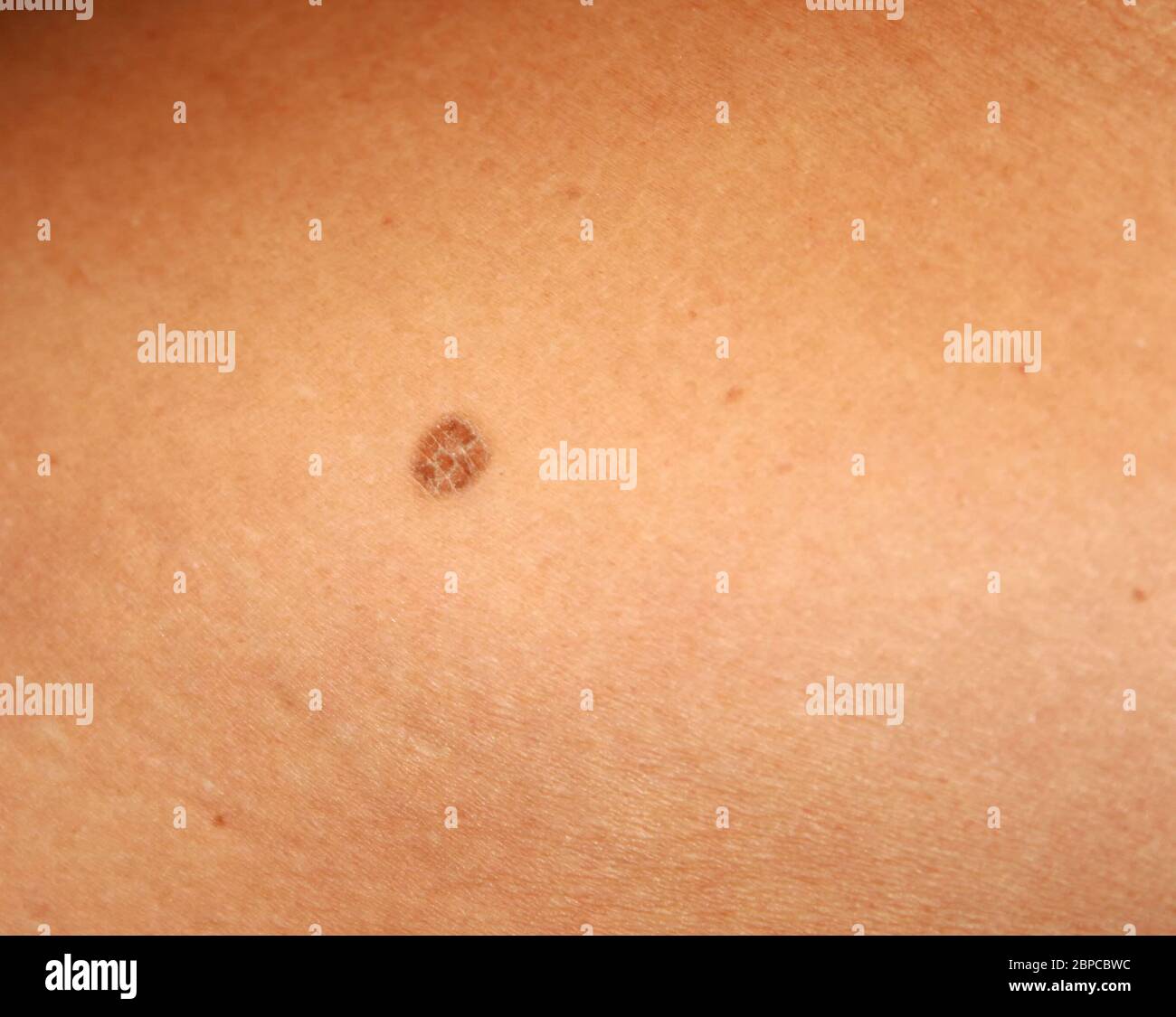 Macchie Sulla Pelle Immagini E Fotos Stock Alamy