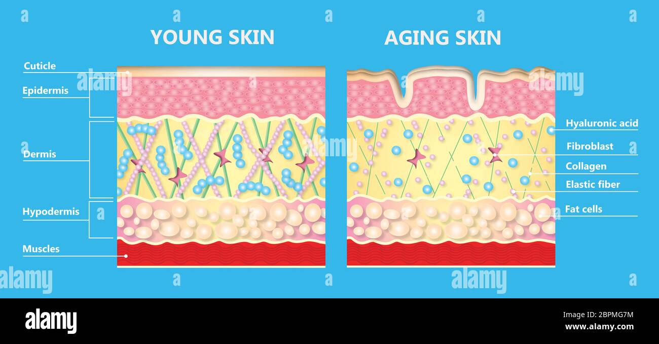 Lo schema della pelle giovane e invecchiamento della pelle che mostra la  diminuzione di collagene e di elastina rotto in pelle più vecchi Foto stock  - Alamy