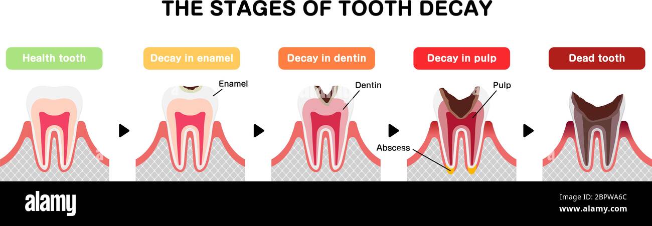 Le fasi di decadimento dei denti / illustrazione vettoriale piatta Illustrazione Vettoriale