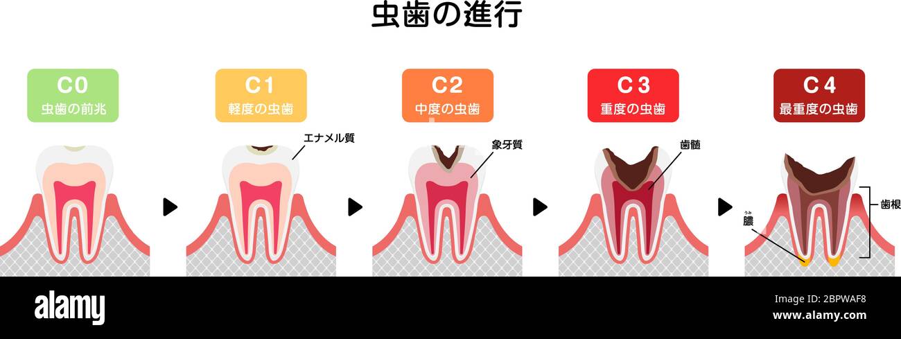 Le fasi di decadimento dei denti / illustrazione vettoriale piatta (giapponese) Illustrazione Vettoriale