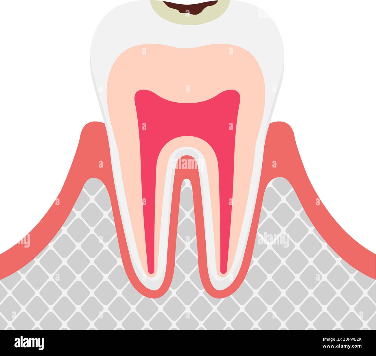 Lo stadio di decadimento/decadimento dei denti in smalto Illustrazione Vettoriale