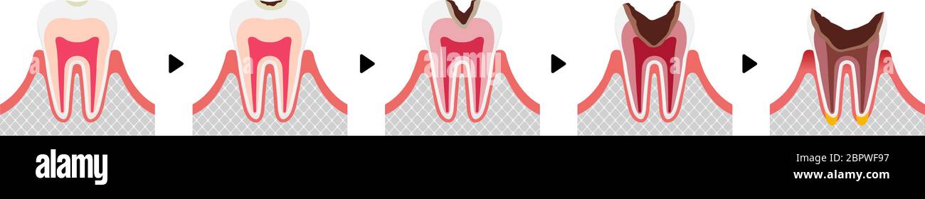 Le fasi di decadimento dei denti / illustrazione vettoriale piatta (senza testo) Illustrazione Vettoriale
