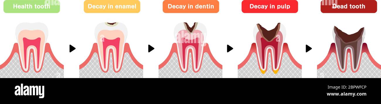 Le fasi di decadimento dei denti / illustrazione vettoriale piatta Illustrazione Vettoriale