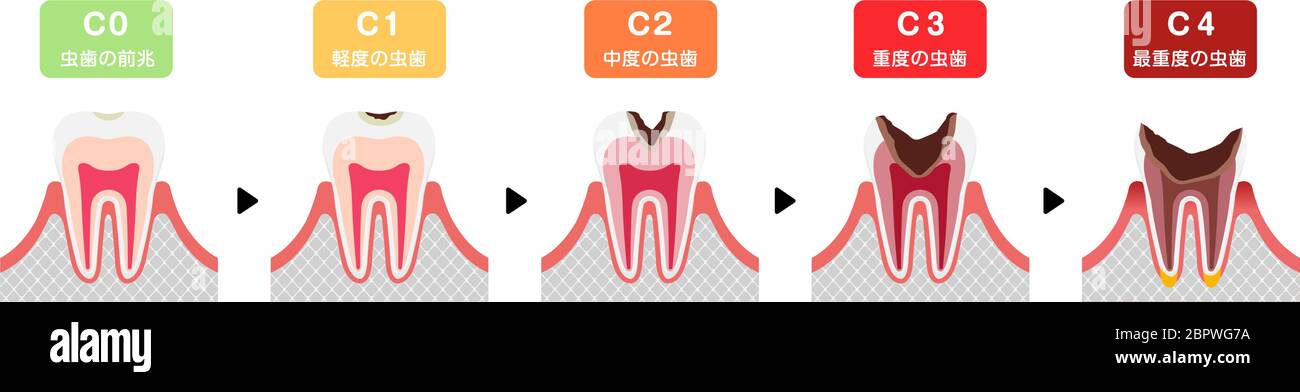 Le fasi di decadimento dei denti / illustrazione vettoriale piatta (giapponese) Illustrazione Vettoriale