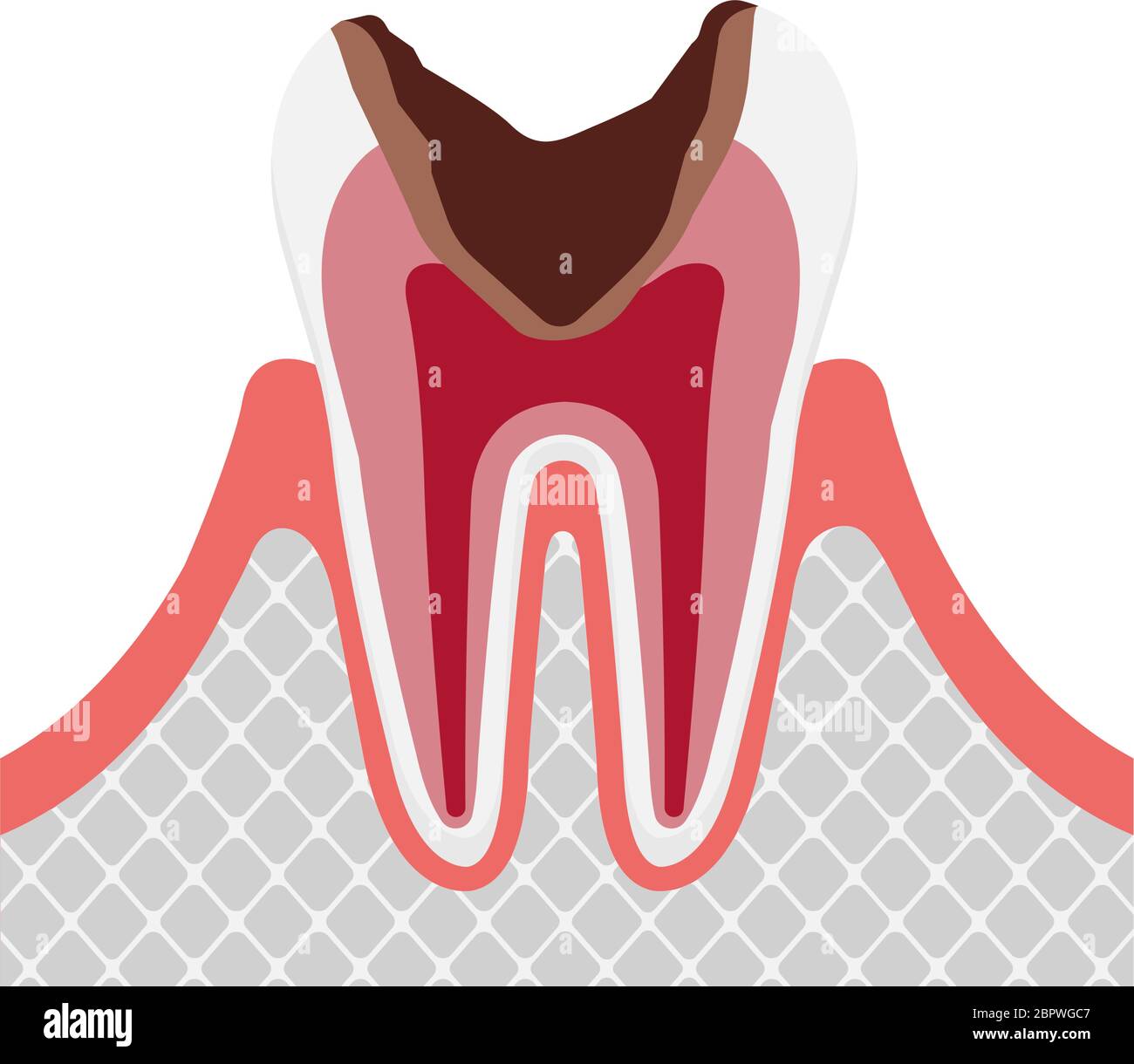 La fase di decadimento / decadimento del dente in polpa Illustrazione Vettoriale