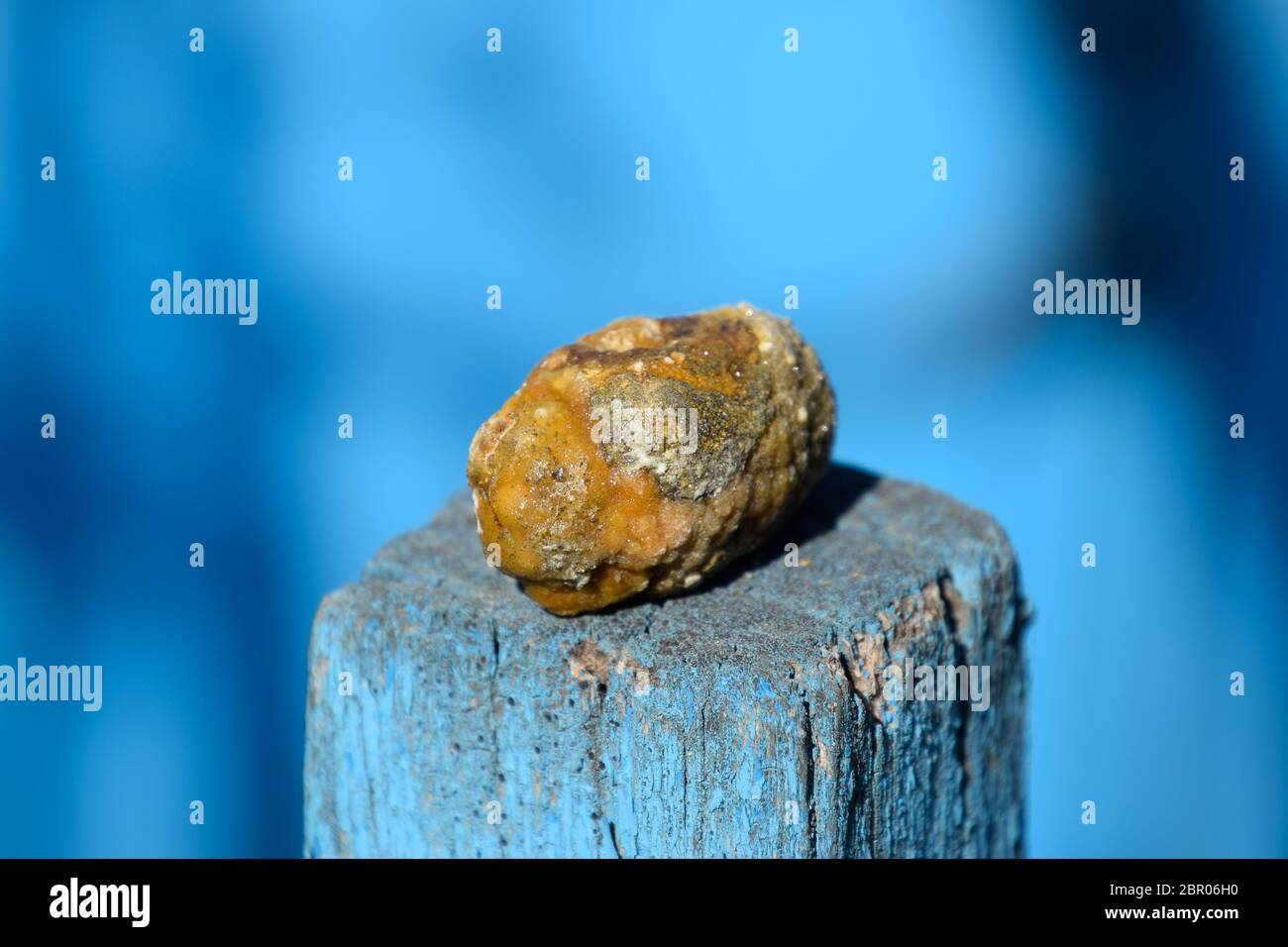 La cistifellea pietre. Il risultato dei calcoli biliari. Calcolo della composizione eterogenea Foto Stock