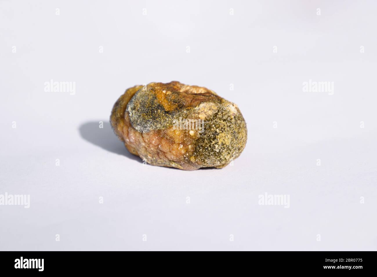 Pietra della cistifellea. Il risultato dei calcoli biliari. Un calcolo di composizione eterogenea. Foto Stock