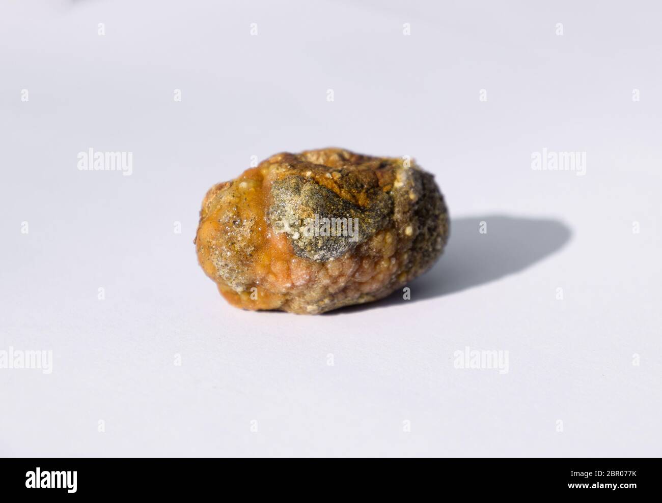 Pietra della cistifellea. Il risultato dei calcoli biliari. Un calcolo di composizione eterogenea. Foto Stock