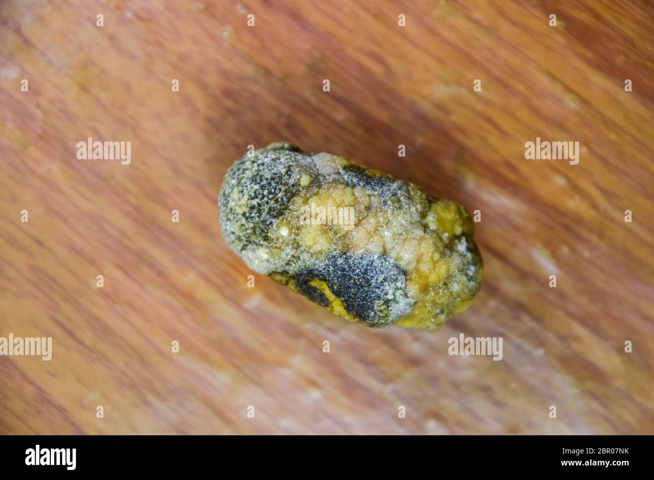 Grandi gallstone, cistifellea pietre. Il risultato dei calcoli biliari. Un calcolo di composizione eterogenea su uno sfondo marrone Foto Stock