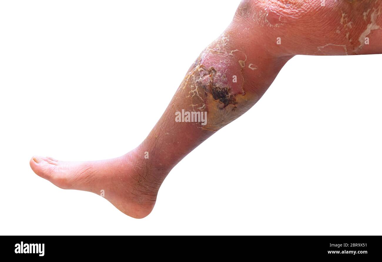 Erisipela infezione batterica sotto la pelle gamba anziani su sfondo bianco  Foto stock - Alamy