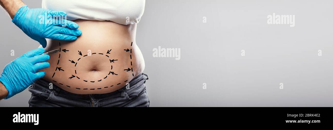 Liposuzione Abdominoplastica Chirurgia plastica. Scalpello di tenuta del chirurgo Foto Stock