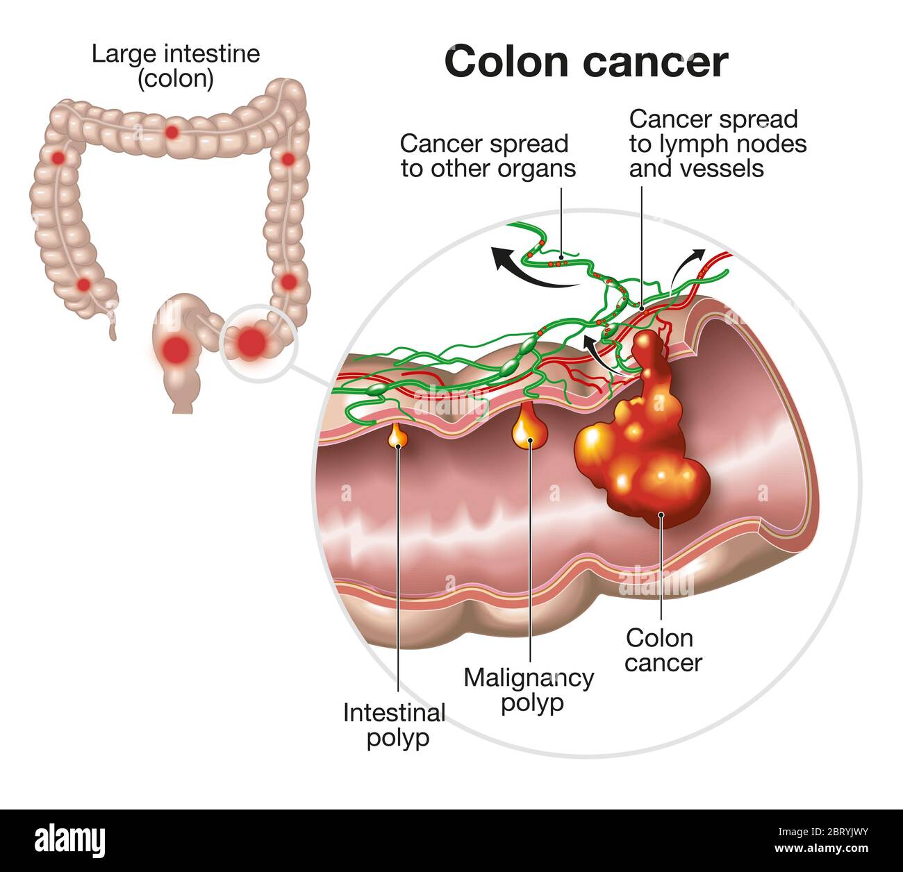 Illustrazione che mostra un apparato digerente di grandi dimensioni con polipi intestinali, tumori del colon e del polipo maligno e diffusione nei linfonodi e nei vasi Foto Stock