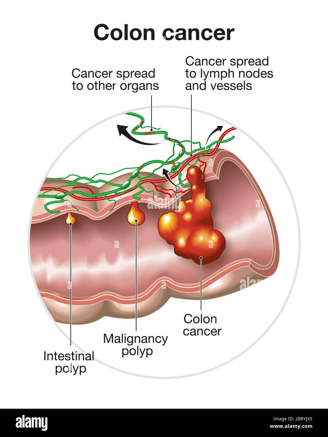 Illustrazione che mostra un apparato digerente di grandi dimensioni con polipi intestinali, tumori del colon e del polipo maligno e diffusione nei linfonodi e nei vasi Foto Stock