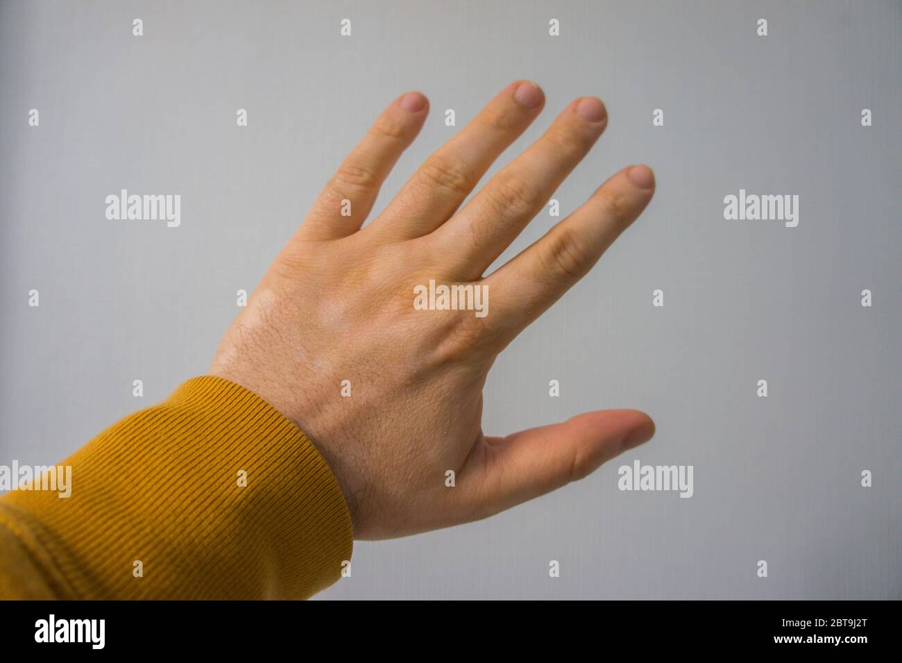Una mano di un uomo caucasico coperta di macchie bianche di vitiligine. Vitiligo è un disturbo autoimmune che causa la perdita di pigmento della pelle. Foto Stock