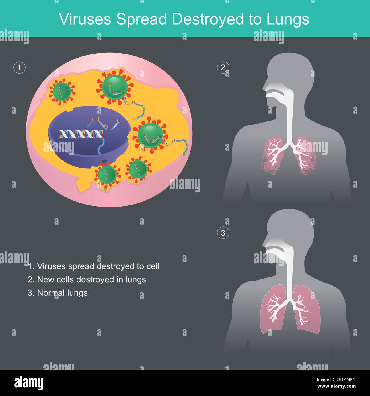 Virus sparso distrutto ai polmoni, Illustrazione mostrano diversi polmoni umani da CORONAVIRUS distrutto tessuto nei polmoni e polmoni normali. Assistenza sanitaria Illustrazione Vettoriale