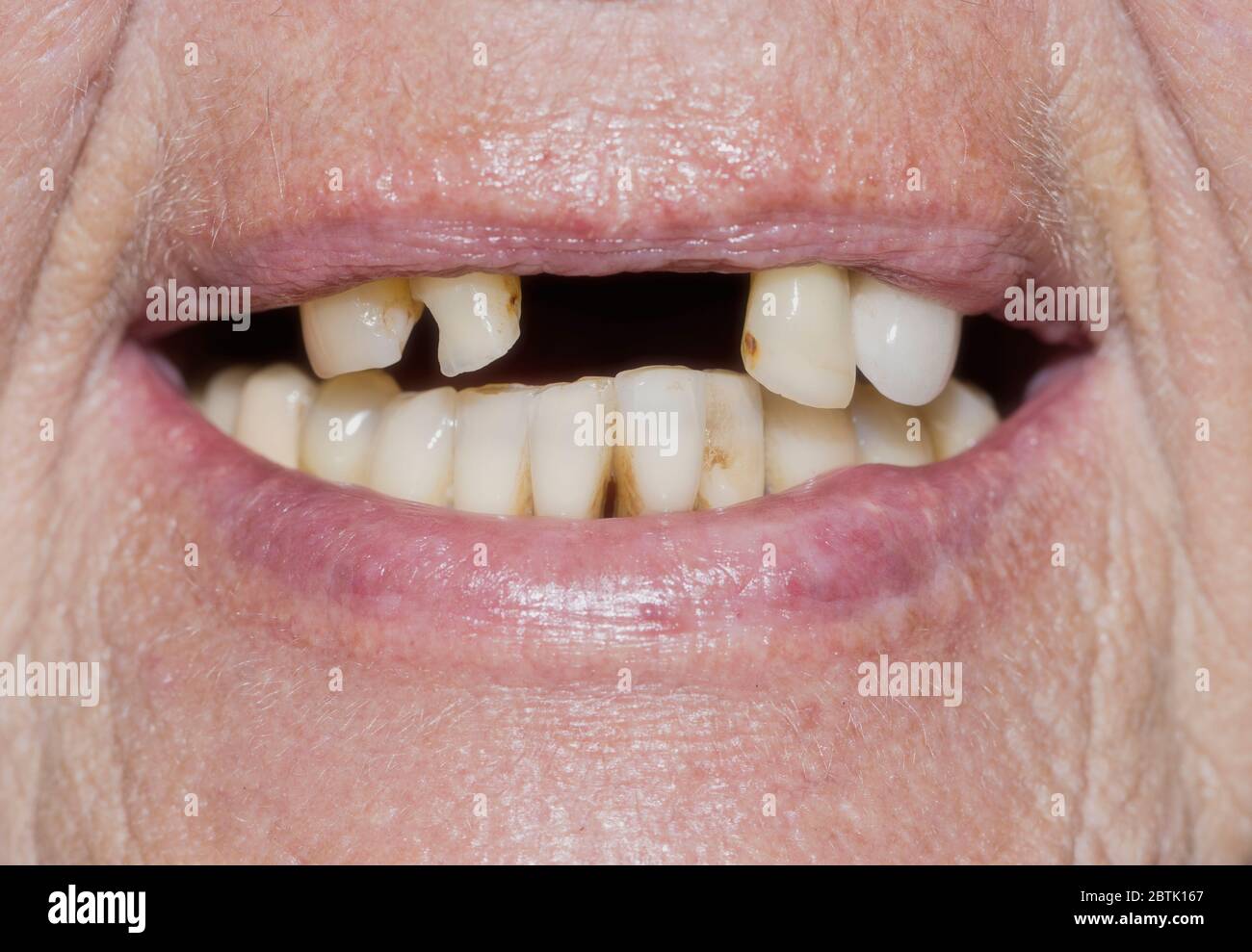 Donna anziana con divari dentali, immagine simbolica della povertà in età avanzata Foto Stock