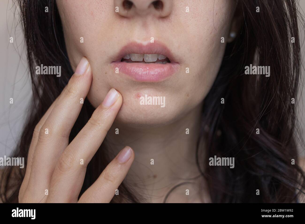 primo piano di giovane bruna caucasica ragazza con un pimple sul mento, toccando il viso con uno sguardo preoccupato Foto Stock