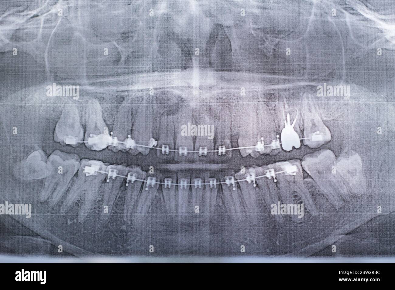Fotografia a raggi X dei denti umani con un sistema di bretelle. Dente di saggezza ritardato Foto Stock