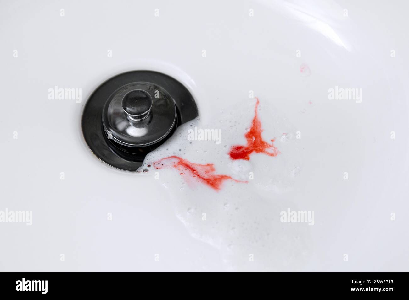 sanguinamento delle gengive durante la pulizia dei denti. dentifricio con sangue nel lavello Foto Stock