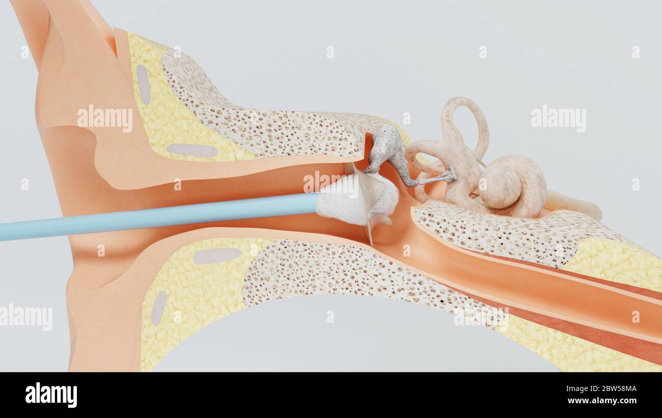 auricolare per la pulizia dell'orecchio con rendering 3d. cera per l'orecchio per la pulizia con un supporto per l'orecchio Foto Stock