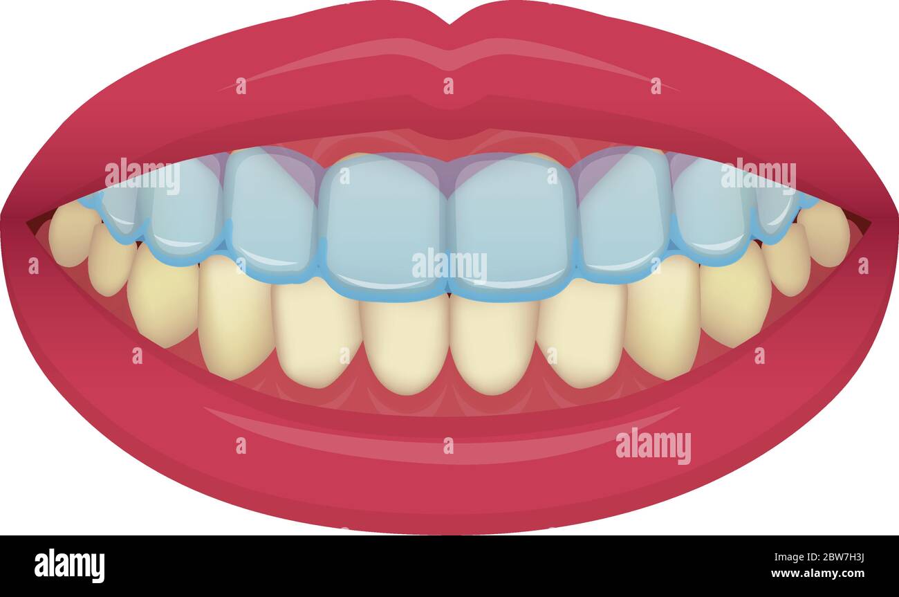 Immagine vettoriale dei denti sbiancanti a casa / nessun testo Illustrazione Vettoriale