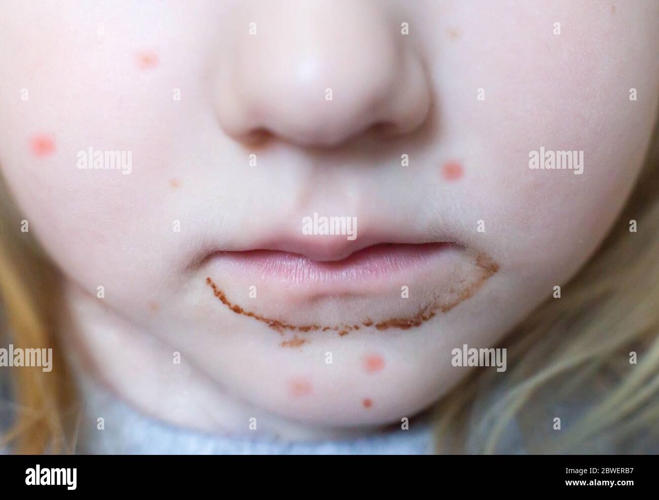 bocca sporca della ragazza dal cioccolato e dai dolci, i pimples rossi sulla sua faccia. Il concetto di allergie infantili ai dolci, primo piano Foto Stock
