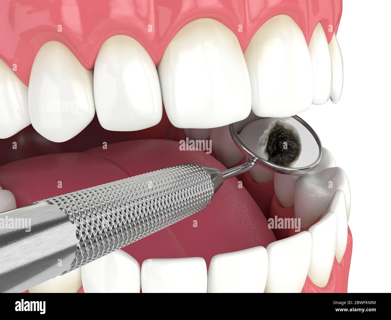 rendering 3d della ganascia con specchio dentale. Concetto di strumenti di diagnostica dentale. Foto Stock