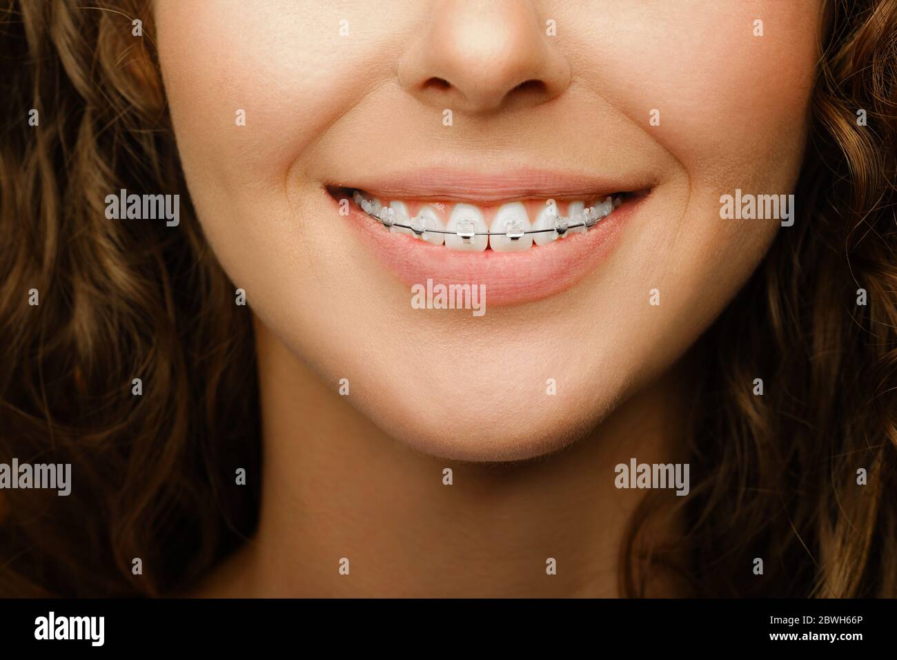 closeup di sorriso femminile grazioso con denti bianchi che indossano i bretelle dentali e che fanno il trattamento ortodontico Foto Stock