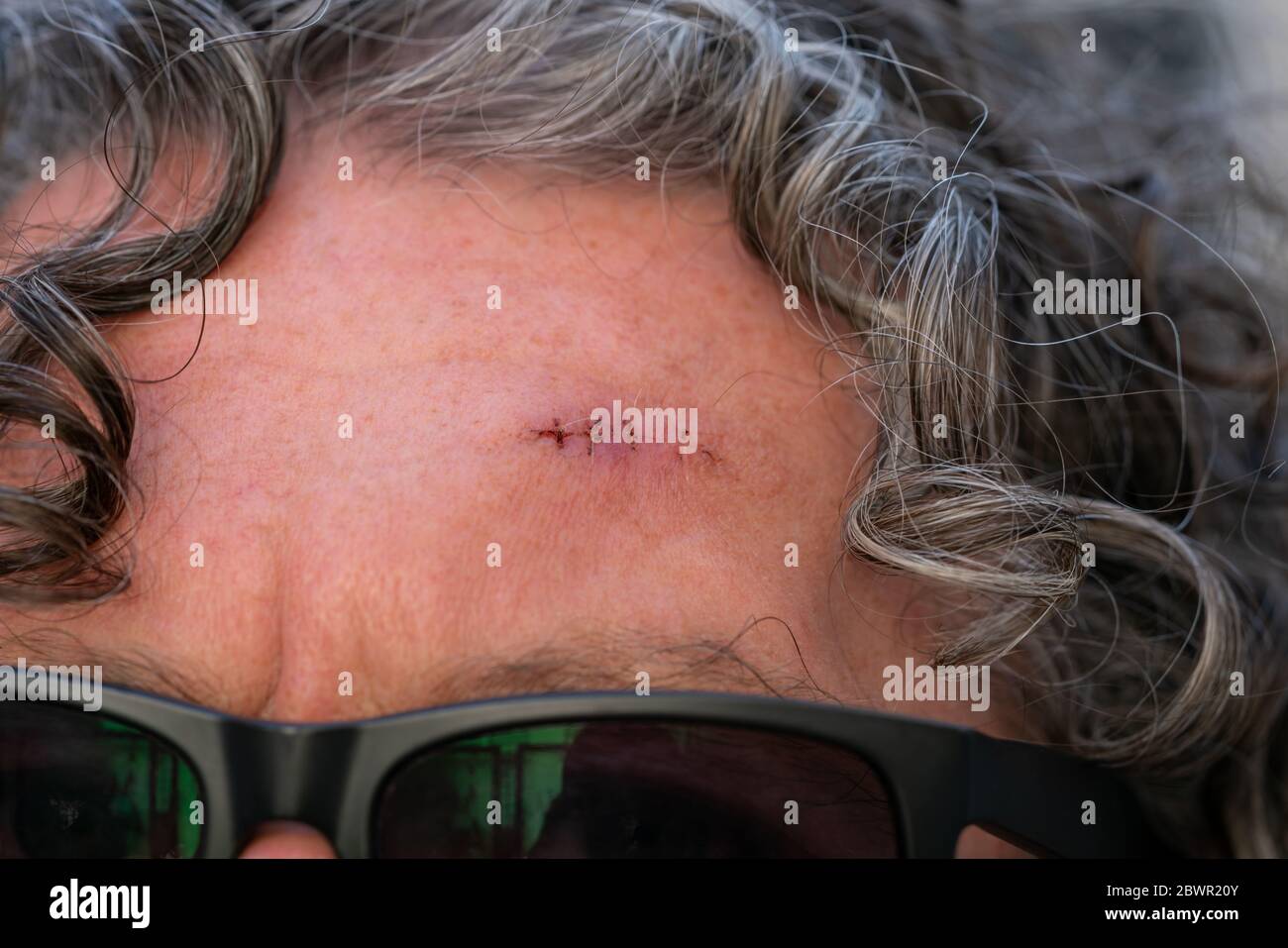 Primo piano di una nuova ferita operatrice con punti che mostrano cicatrice su una fronte mans. Uomo anziano che indossa occhiali da sole e capelli ricci che piangano. Foto Stock