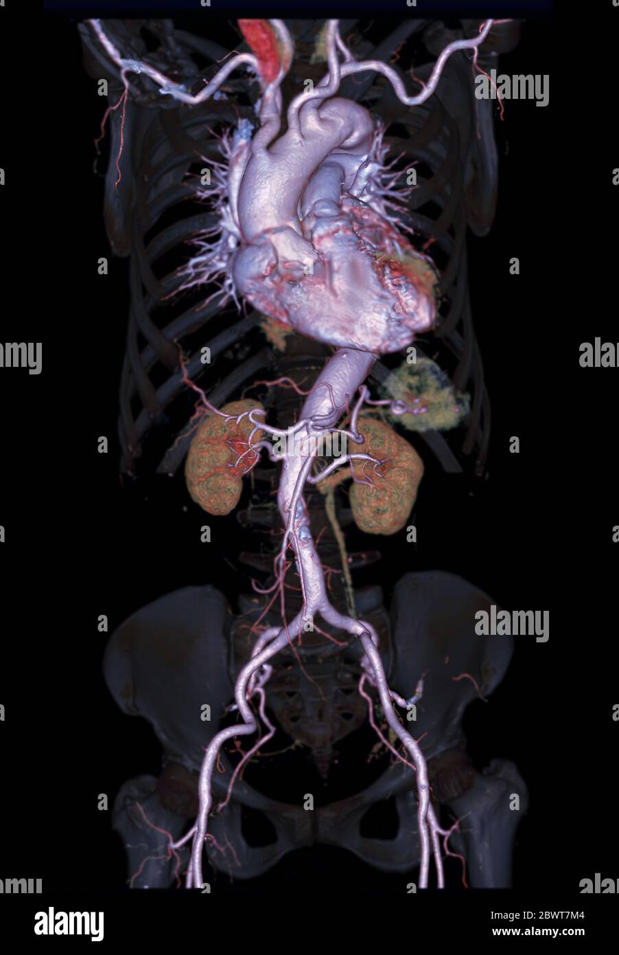 Immagine di rappresentazione 3D dell'aorta addominale CTA su scheletro trasparente . Foto Stock
