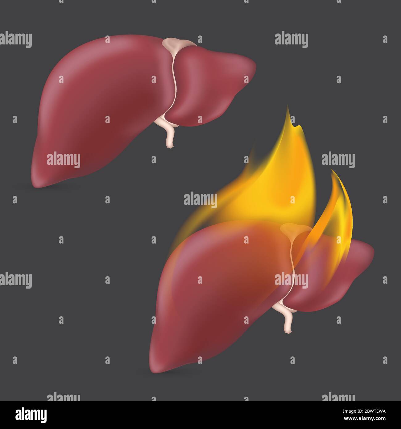 Fegato anatomico in fiamme. Organo umano realistico del sistema di digestione interna in fiamma. Illustrazione vettoriale Illustrazione Vettoriale