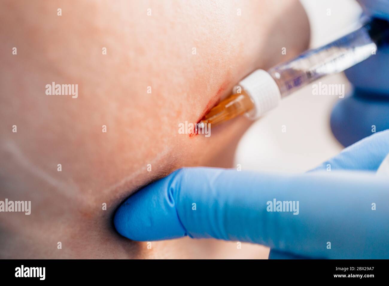 Le iniezioni intradermiche indolore e sicure sono efficaci per correggere le rughe mimiche e senili, incluse le pieghe triangolari nasolabiali Foto Stock