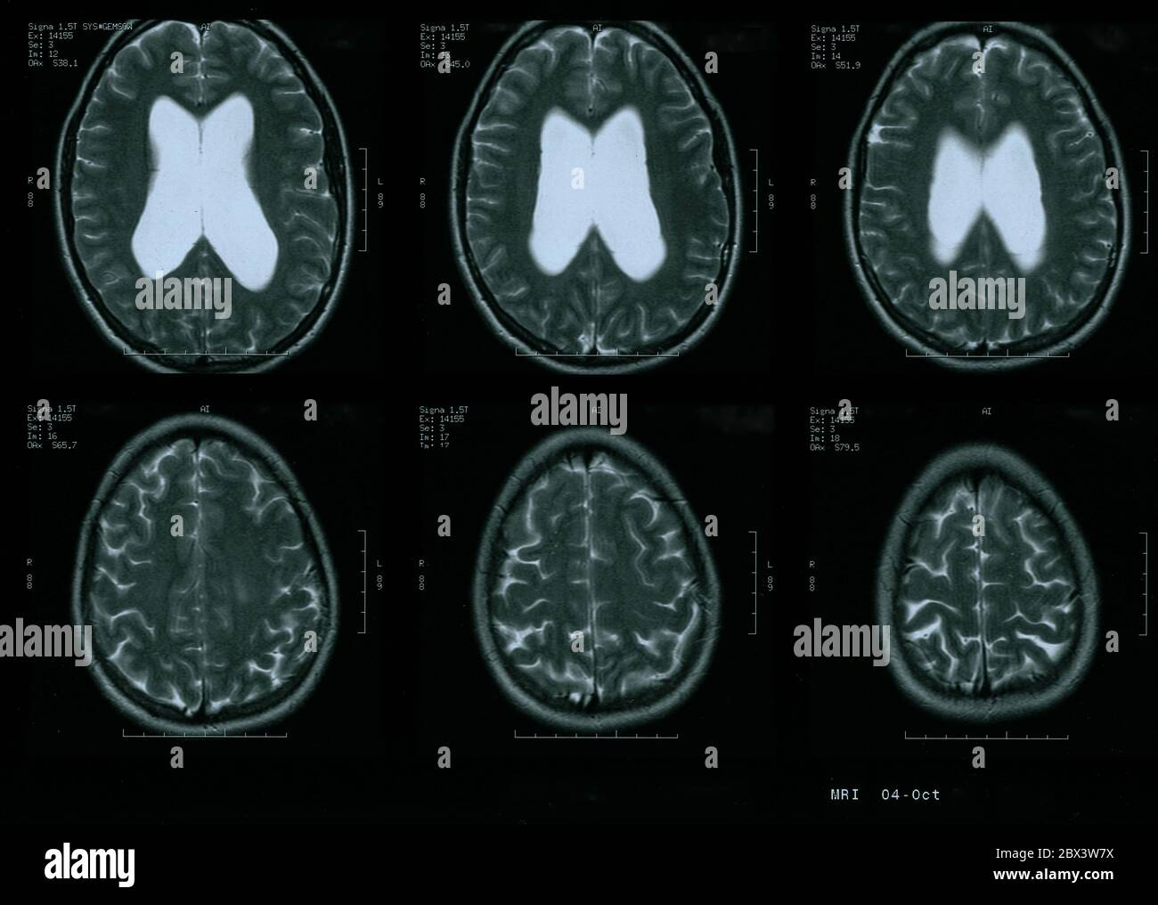 Scansione MRI di 35 anni di cervello femminile con idrocefalo lieve Foto Stock