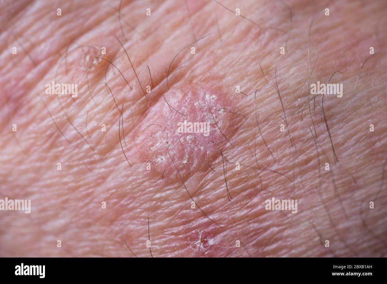 Eczema grezzo con rossore, rigonfiamenti, urti e fiocchi sul polso di un uomo. Questo può essere trattato con criochirurgia o con alcuni unguenti Foto Stock