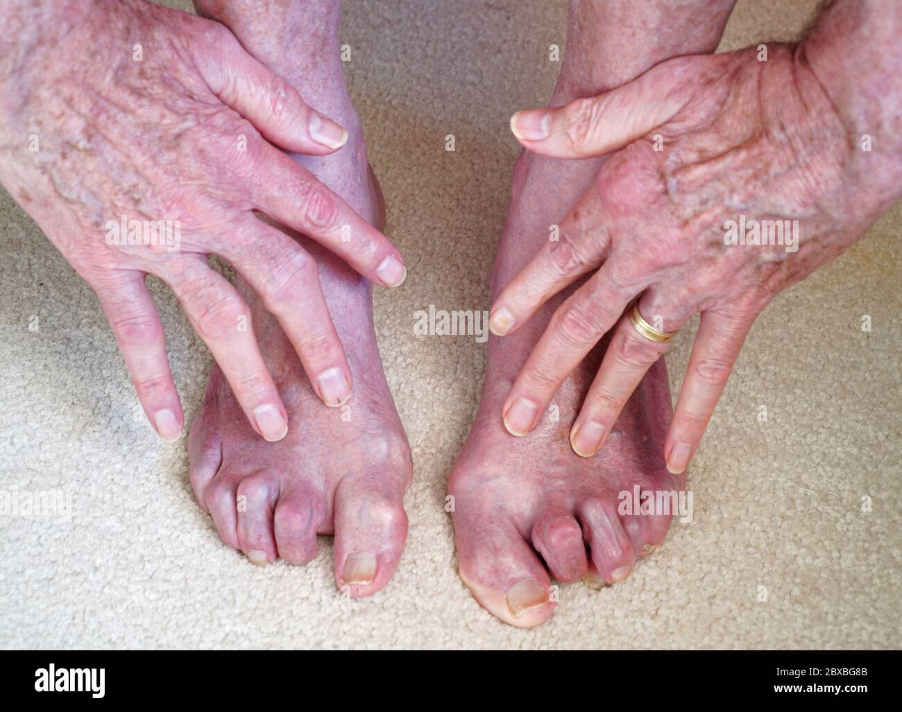 Dita e dita dei piedi di 73 anni con artrite reumatoide per 35 anni. Foto Stock