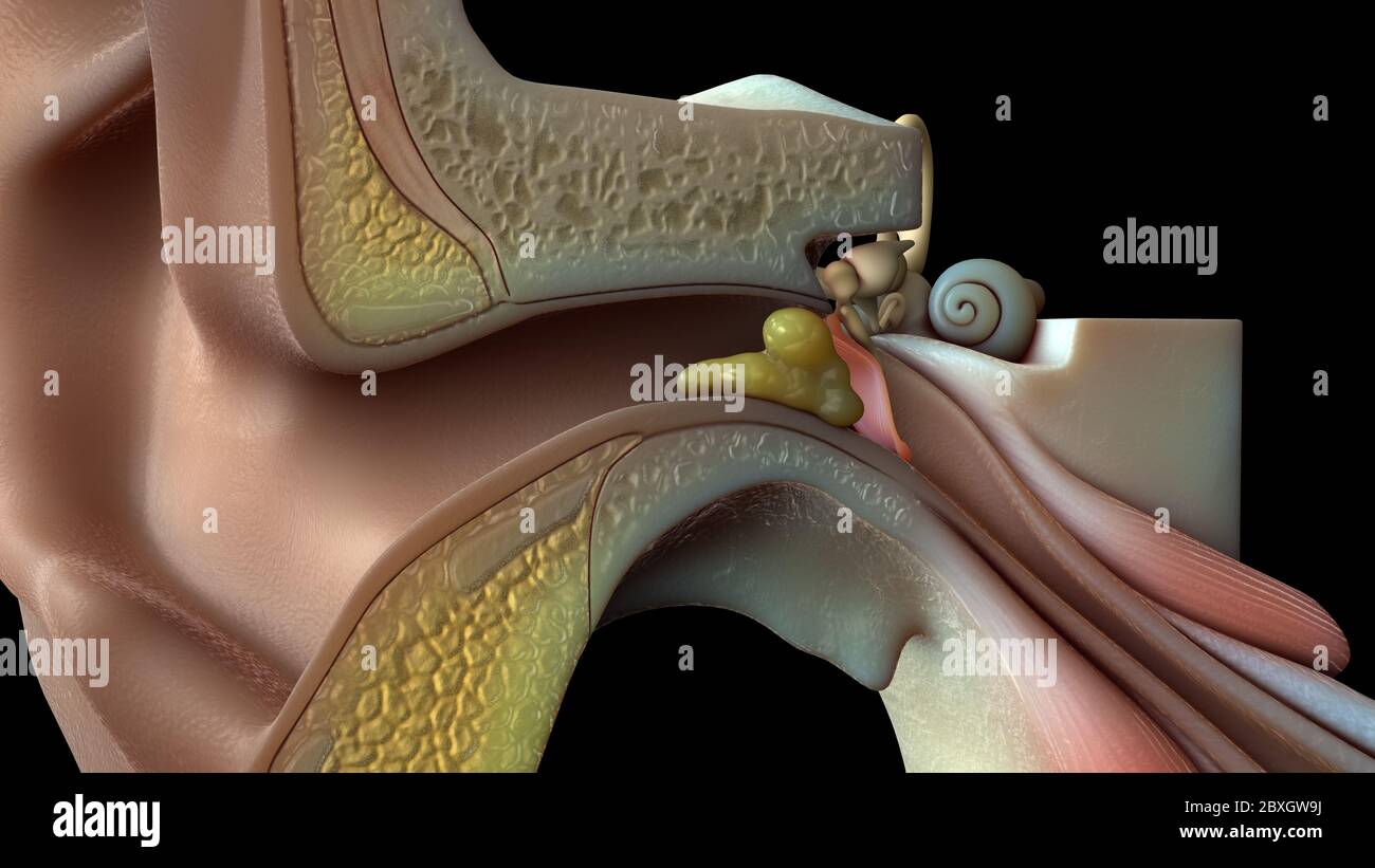Sezione trasversale dell'orecchio con cera Foto Stock