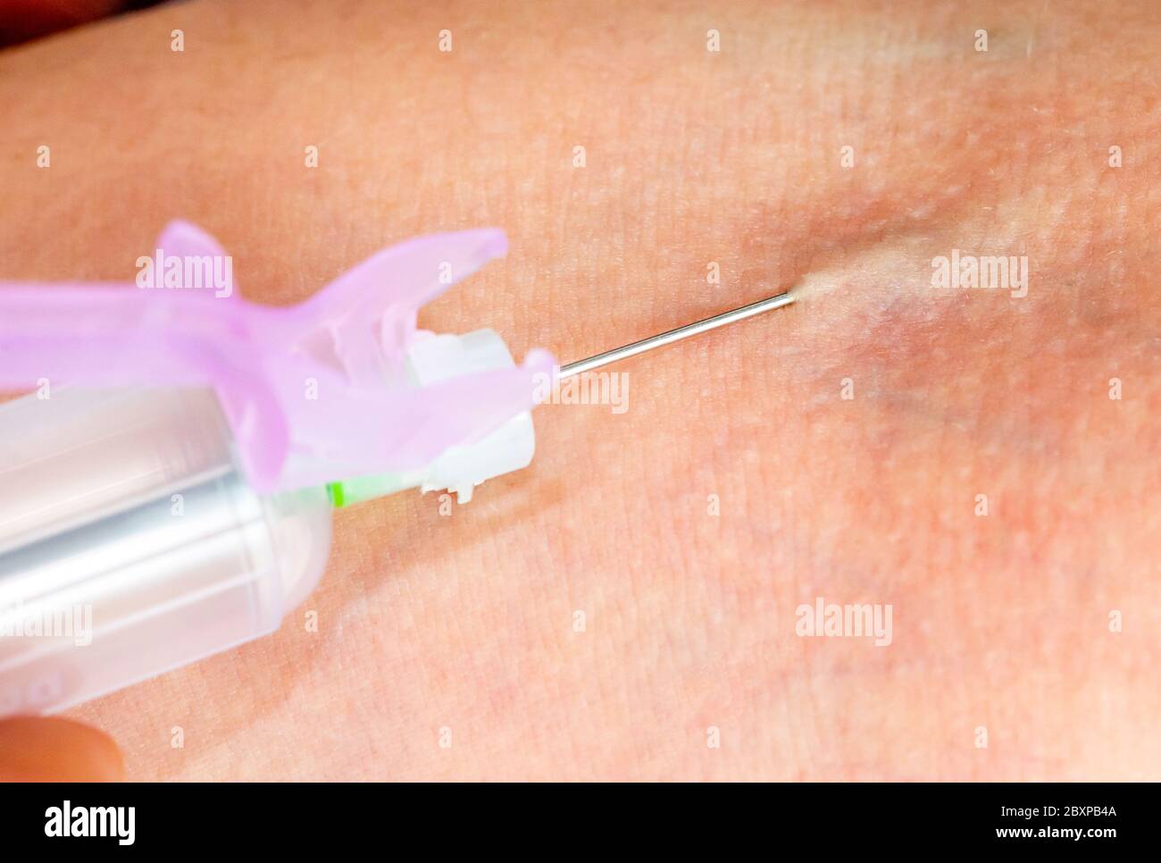 Un medico preleva un campione di sangue da un braccio del paziente Foto Stock