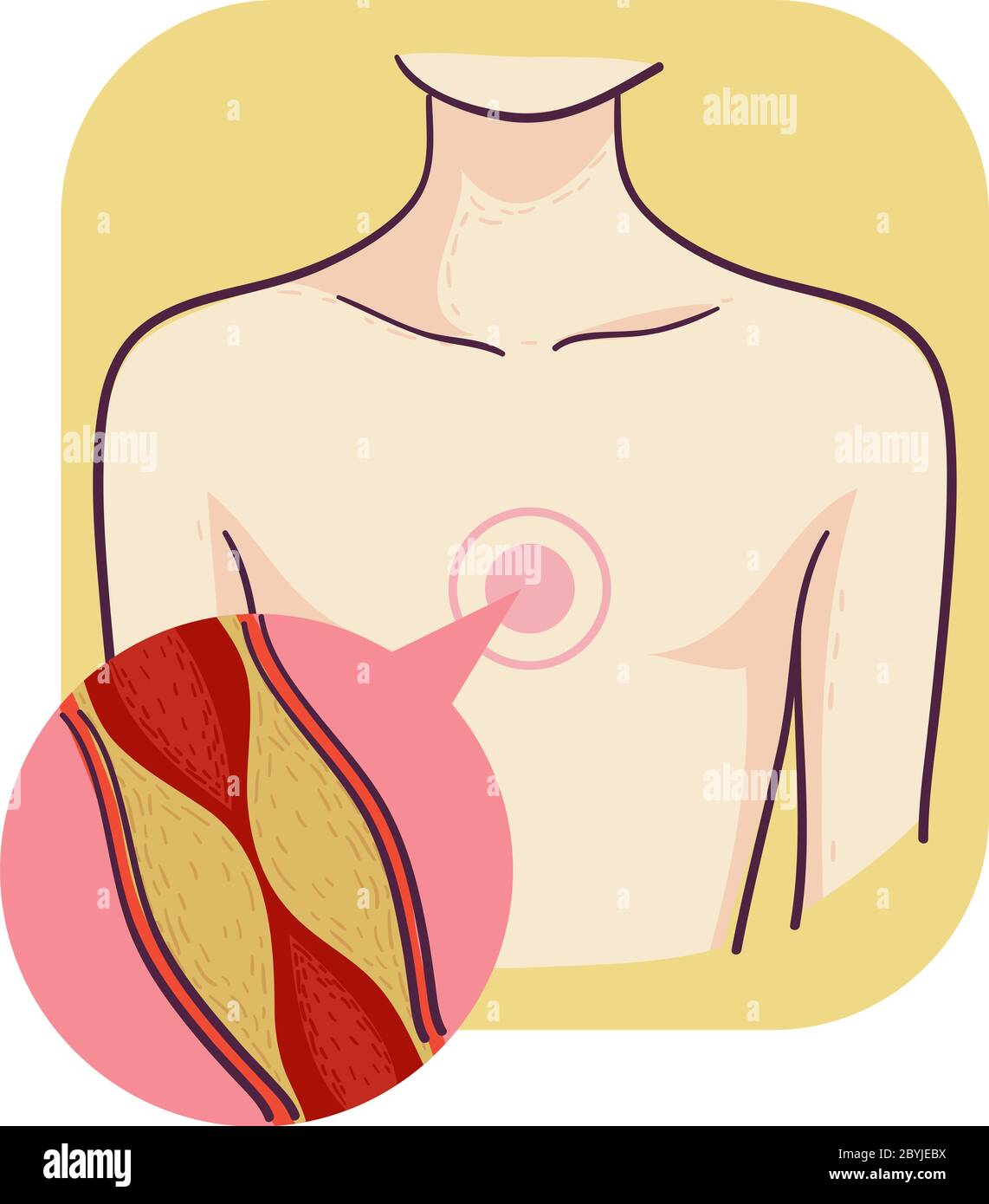 Illustrazione di un uomo con blocco di placca ingrandita nel cuore che ha bisogno di chirurgia di bypass dell'arteria coronaria Foto Stock